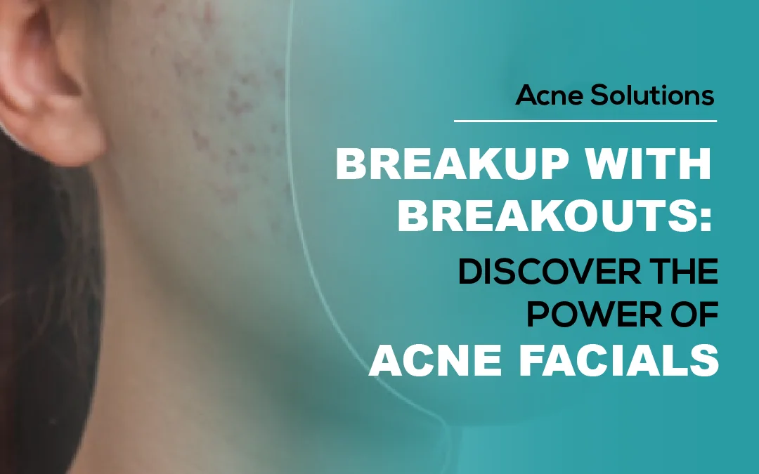 Break Up with Breakouts: Discover the Power of Acne Facials