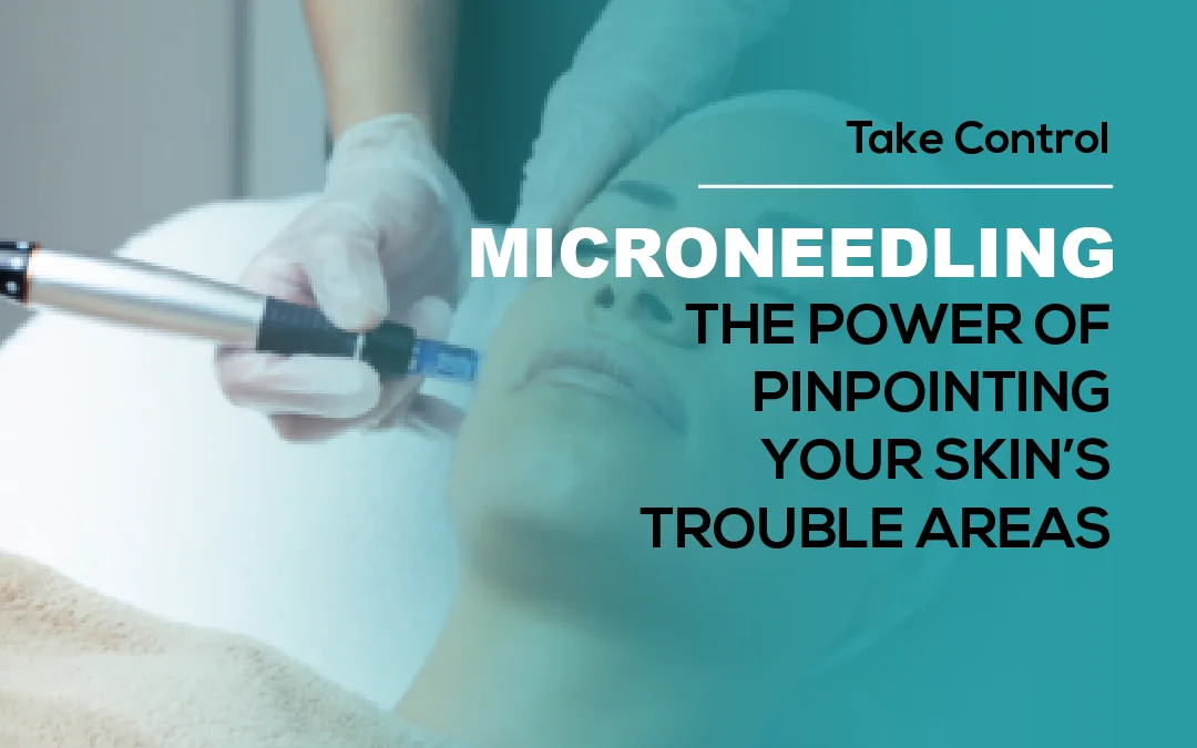 Microneedling: the Power of Pinpointing Your Skin’s Trouble Areas