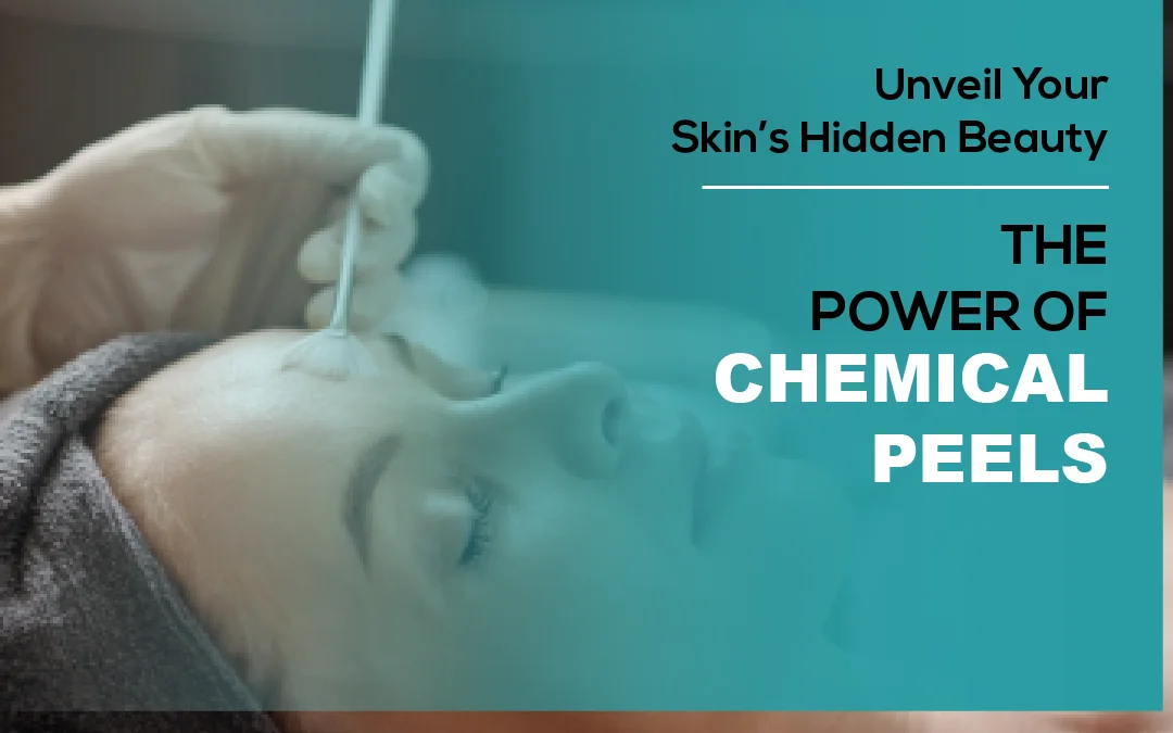 Unveil Your Skin’s Hidden Beauty: The Power of Chemical Peels