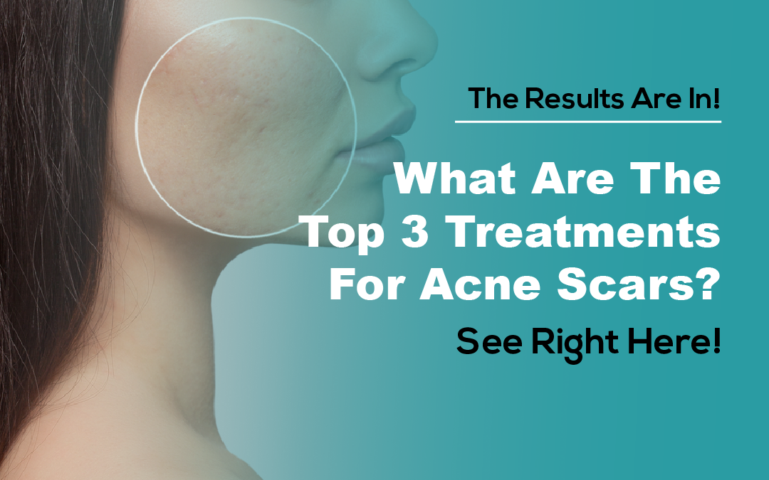 What Are the Top 3 Treatments for Acne Scars? See Right Here!
