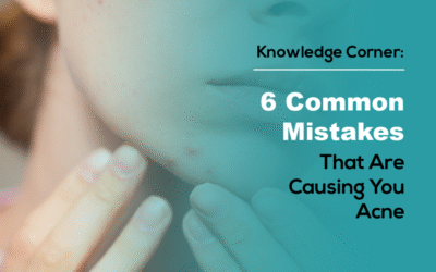 6 Common Skincare Mistakes That Are Causing You Acne