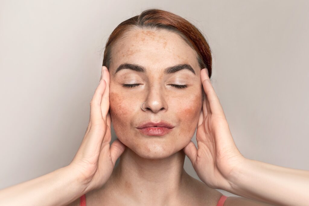 Woman with visible pigmentation and dark spots on her face.
