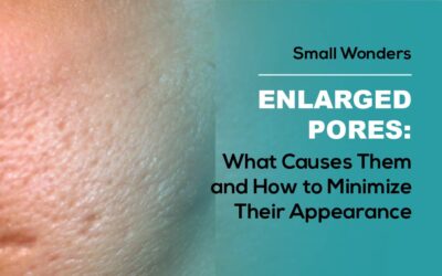 Enlarged Pores: What Causes Them and How to Minimize Their Appearance