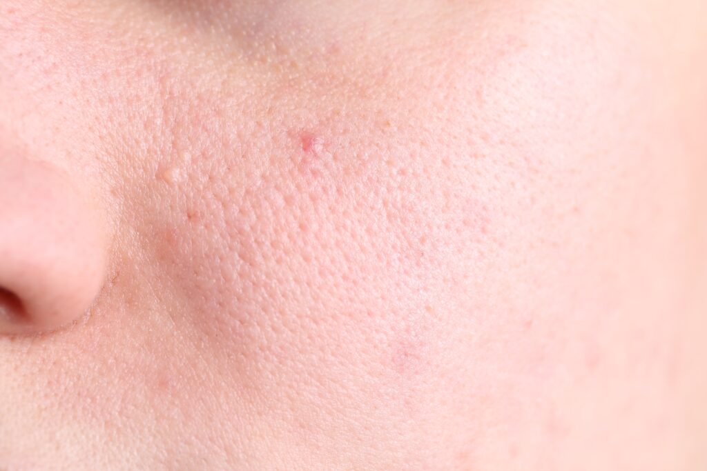 Close-up of a woman’s face showing enlarged pores and uneven skin texture on the cheeks.