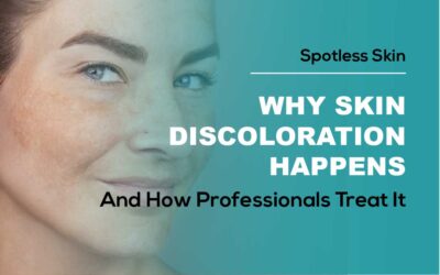 Why Skin Discoloration Happens and How Professionals Treat It