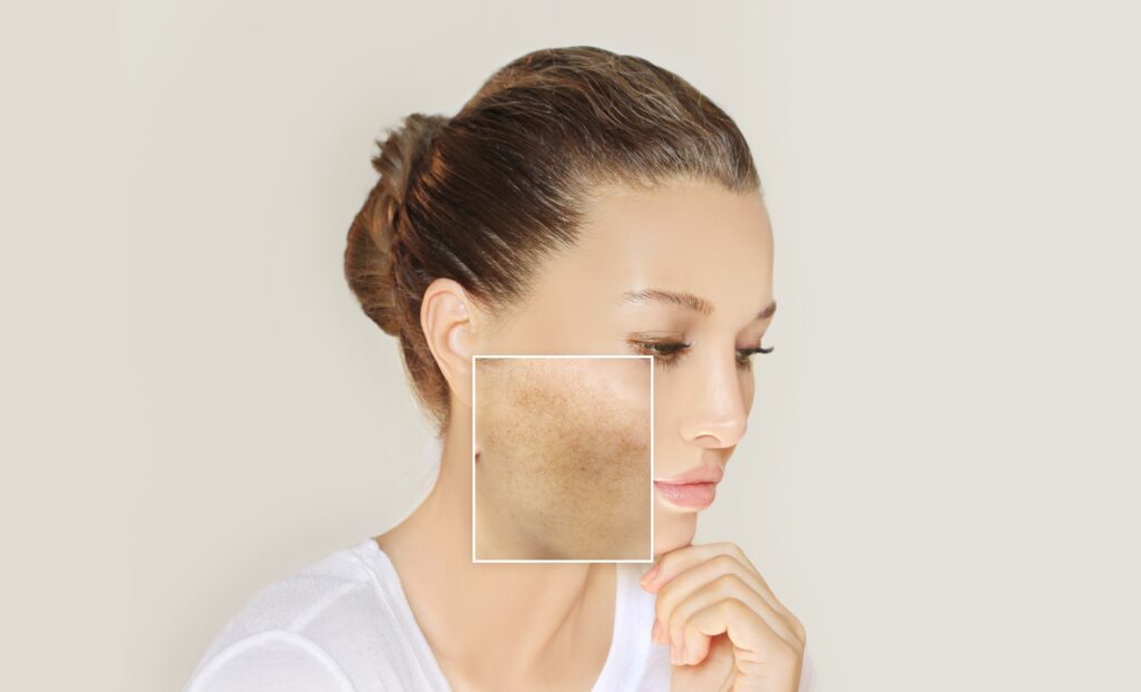 Close-up of hyperpigmentation and uneven skin tone on a woman's cheek.