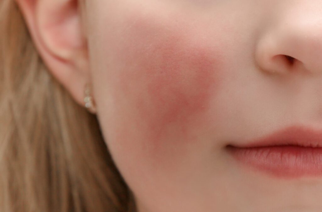 Person experiencing facial redness and irritation after prolonged exposure to Florida heat and humidity.